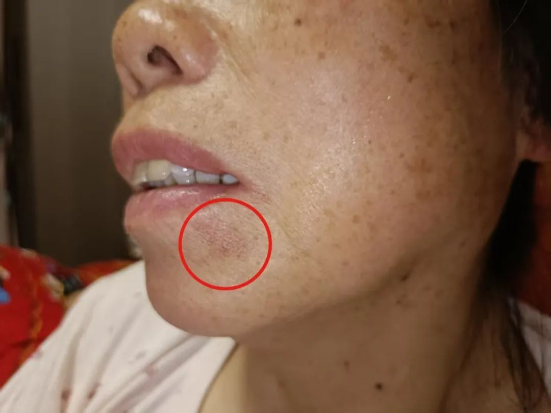 密密麻麻，1岁宝宝长满“痘痘”！竟是因为姥姥的一个疏忽