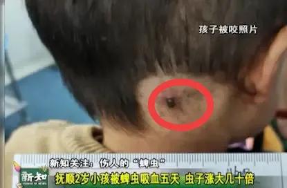 脾虫咬后的伤口图_被蜱虫咬伤的处理方法_蜱虫叮咬的危害与预防