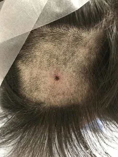 蜱虫叮咬症状_蜱虫咬人案例_脾虫咬后的伤口图