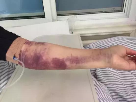 蜱虫叮咬急救方法_夏季蜱虫叮咬症状_脾虫咬后的伤口图