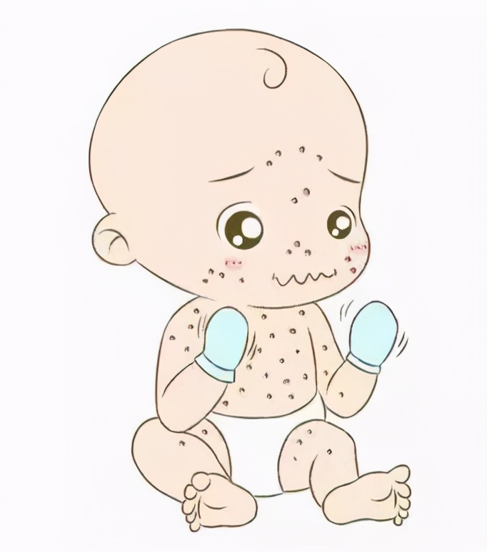 带状疱疹病毒性水痘怎么引起的_水痘病毒 带状疱疹·_病毒带状疱疹水痘图片