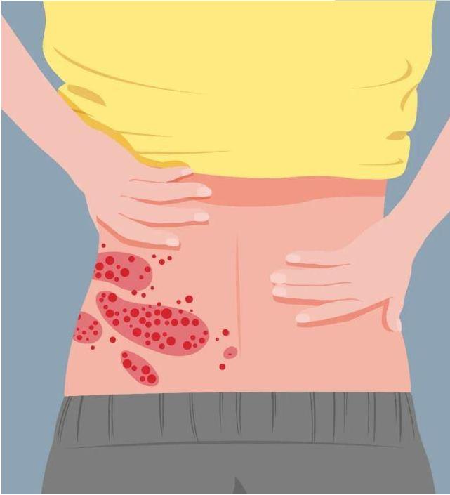 带状疱疹病毒性水痘怎么引起的_水痘病毒 带状疱疹·_病毒带状疱疹水痘图片