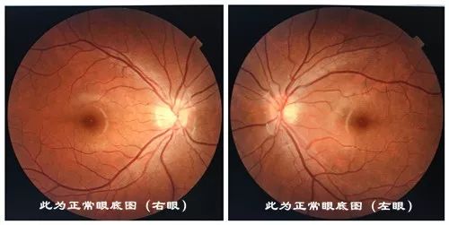 眼囊虫图_眼囊虫图片_眼囊虫病早期症状