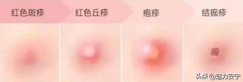 水痘临床表现症状_水痘治疗和护理方法_艾滋病与水痘