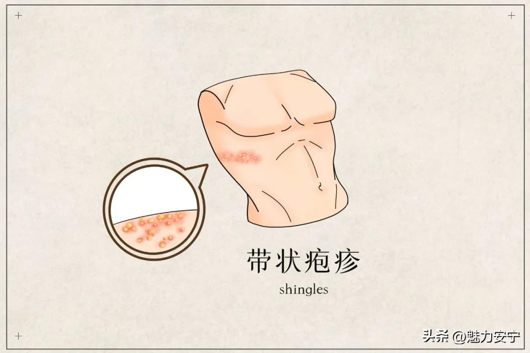 水痘治疗和护理方法_水痘临床表现症状_艾滋病与水痘