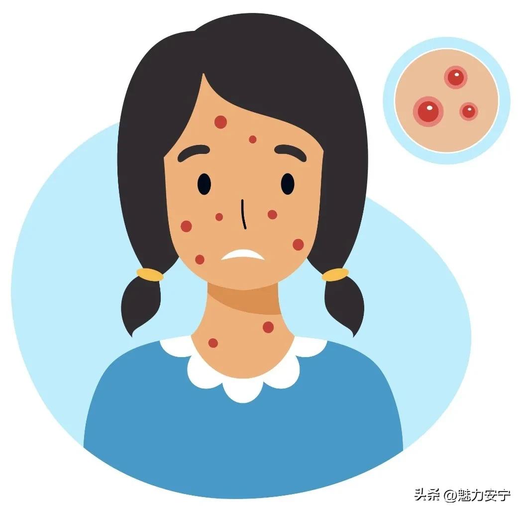 水痘治疗和护理方法_水痘临床表现症状_艾滋病与水痘