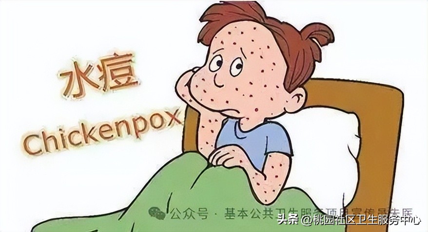 水痘疫苗接种时间_水痘预防措施_艾滋病与水痘