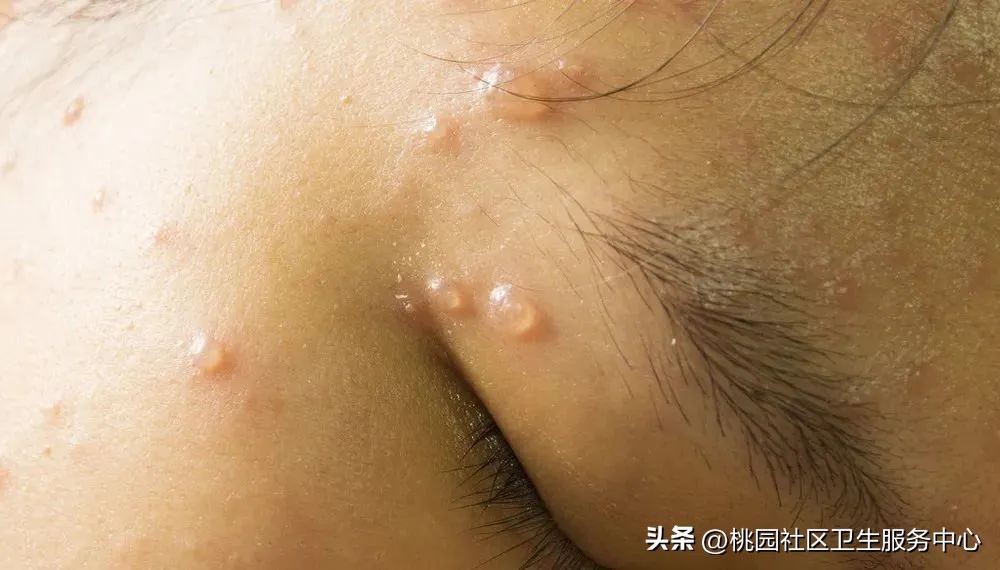水痘预防措施_艾滋病与水痘_水痘疫苗接种时间
