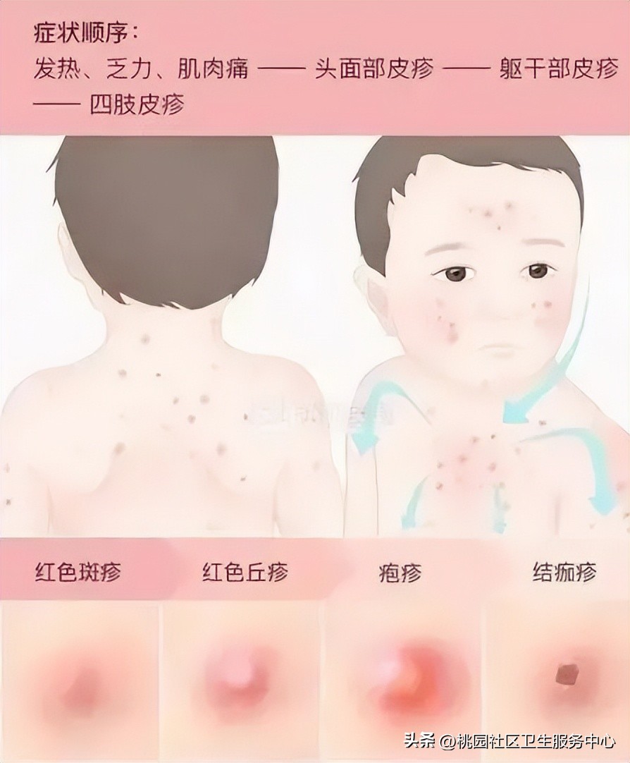 水痘疫苗接种时间_艾滋病与水痘_水痘预防措施