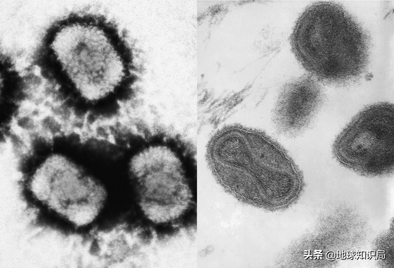 中国古代免疫学_牛痘病毒 天花病毒_天花历史
